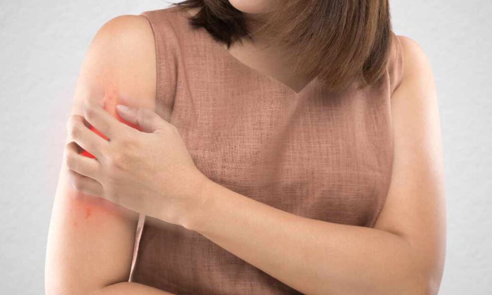 Psoriasis