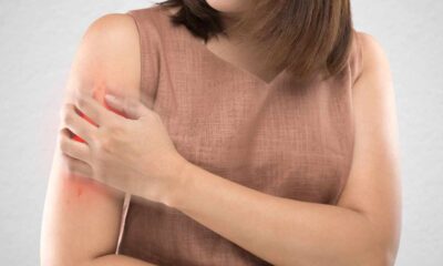 Psoriasis