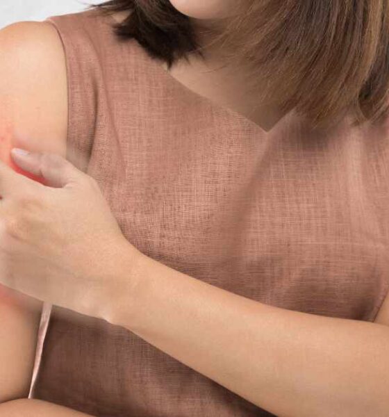 Psoriasis
